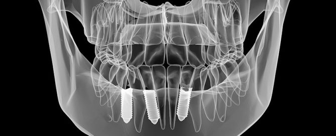 implant tarihi