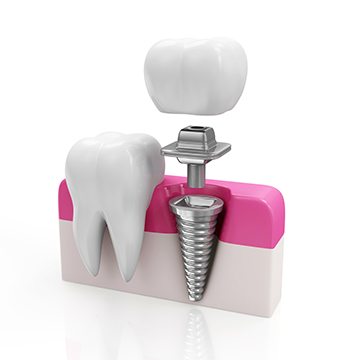 implant nasıl yapılır implant nasıl yapılır