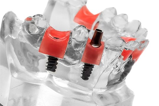diş implantları nedir diş implantı nedir