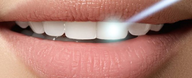 diş beyazlatma bleaching