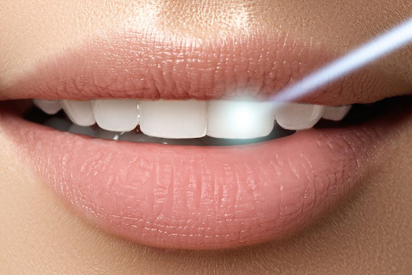 Diş Beyazlatma (Bleaching) Hakkında Merak Ettikleriniz