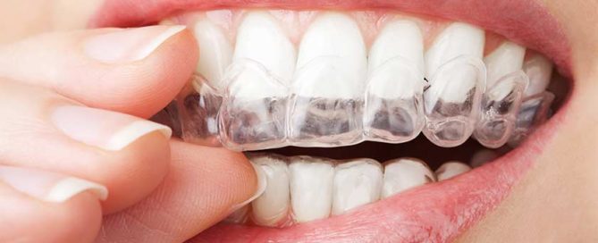 şeffaf braket invisalign ortodonti