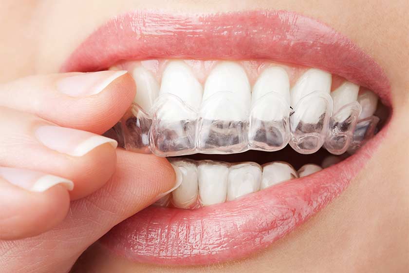Invisalign (Şeffaf Aparey)