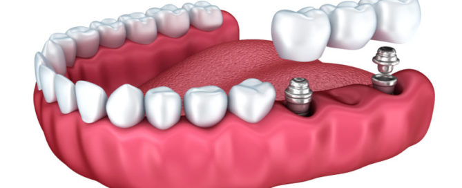 implant tedavisi