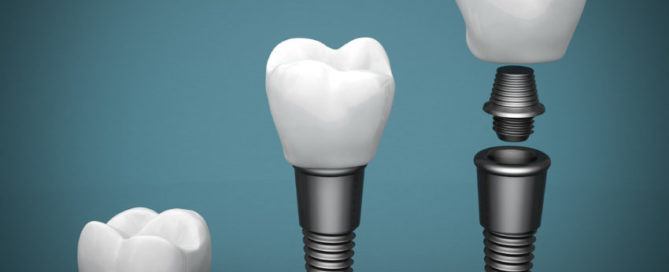 Diş implantlarının uygulanabilmesi için gereken şartlar