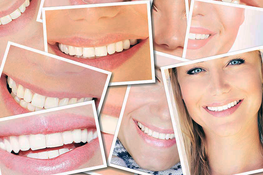 10 Gründe, um sich für Laminate Veneers (Keramikverblendungen) zu entscheiden