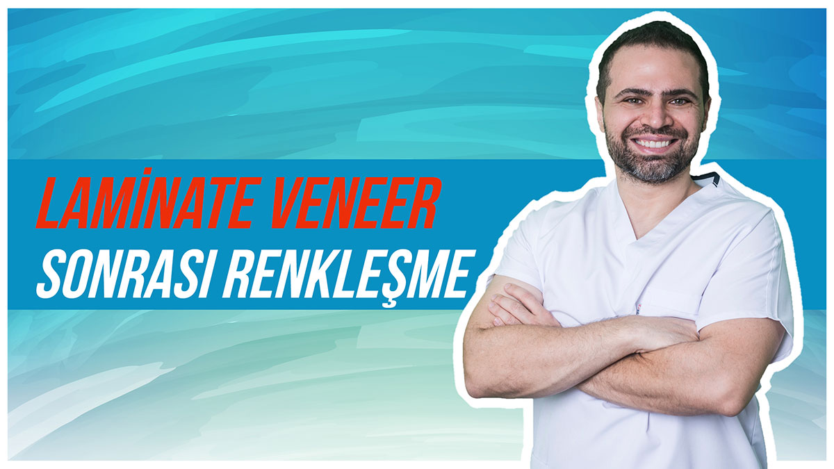 Laminate Veneer Sonrası Dişlerde Renkleşme Yaşanır mı?